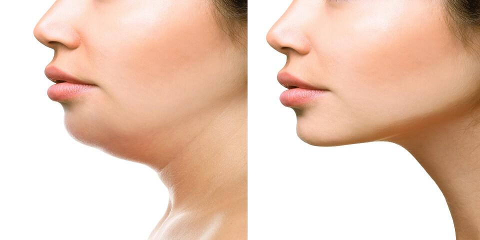 Chin augumentation clinic in Bangalore