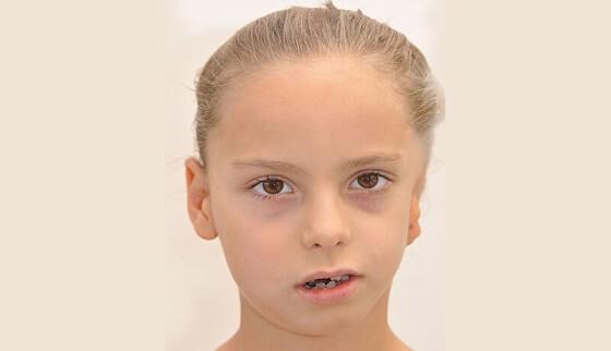 Hemifacial Microsomia Treatment in Bangalore