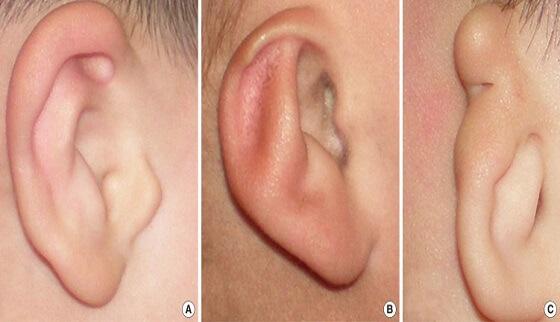 Microtia Treatment In Bangalore