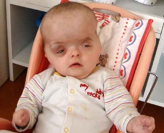 Crouzon Syndrome