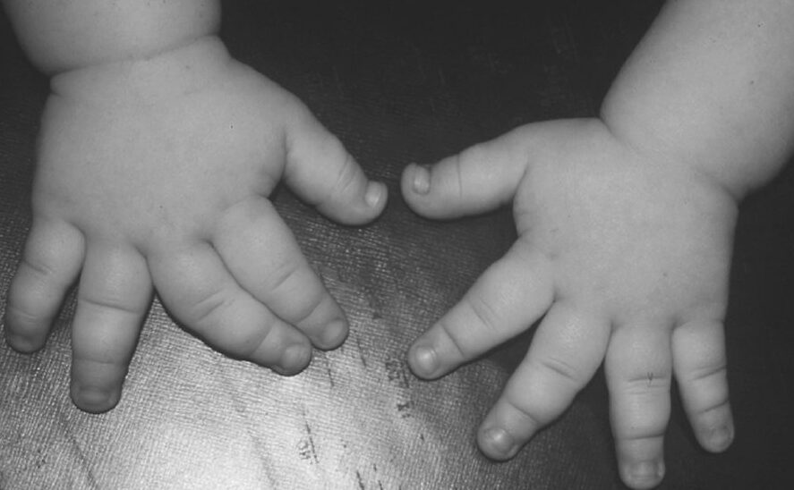 Pfeiffer Syndrome