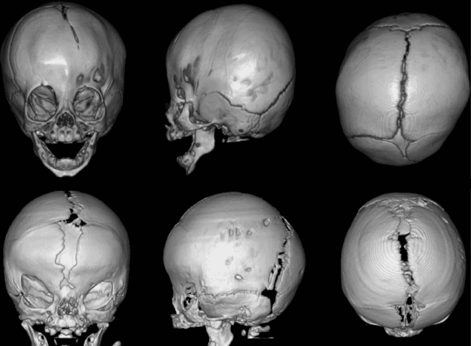 Muenke Syndrome Treatment