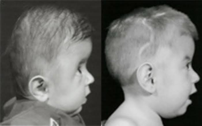 Muenke Syndrome 1