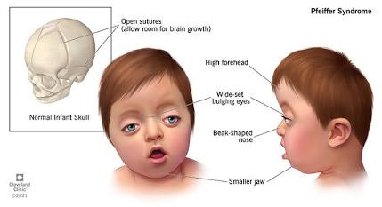 Pfeiffer Syndrome Treatment in Bangalore
